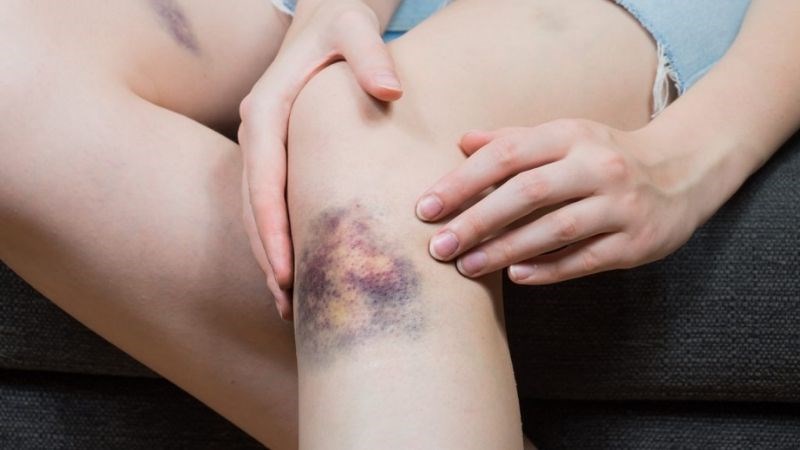 10 tegn på blodpropper, som kvinder overser